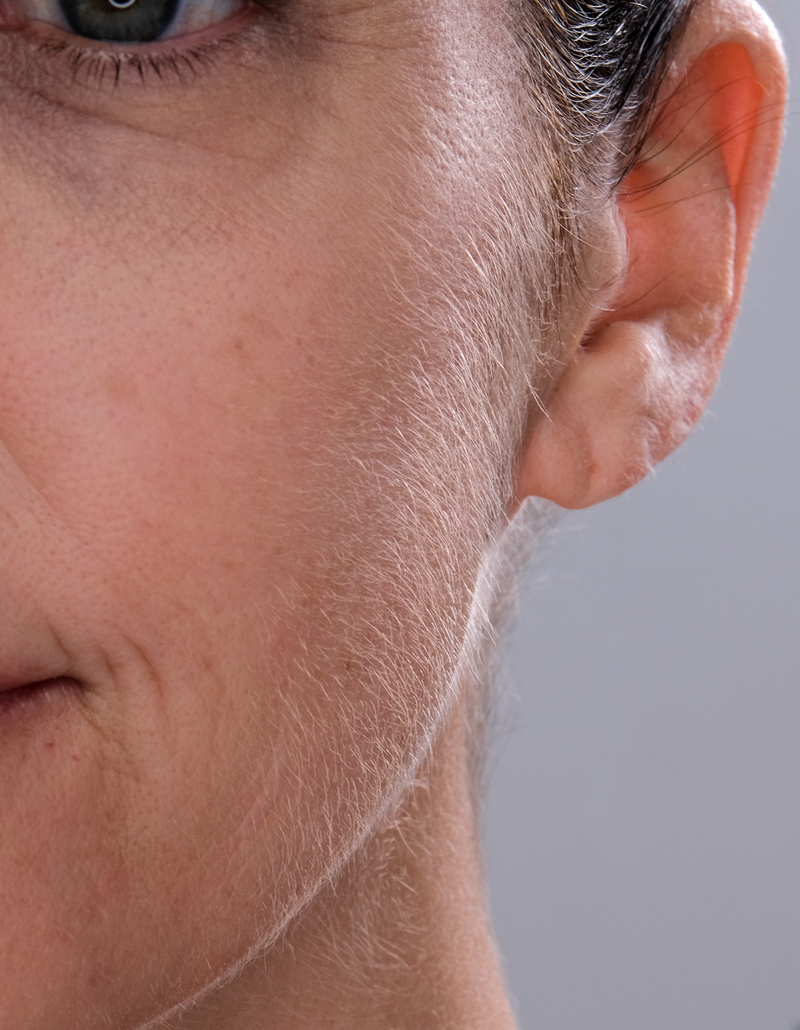 Side-profile cheek result before using Sonicsmooth Pro+
