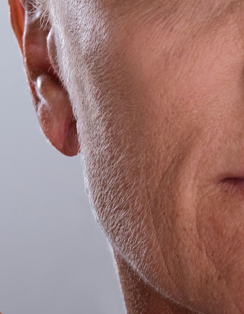 Jawline result before using Sonicsmooth Pro+