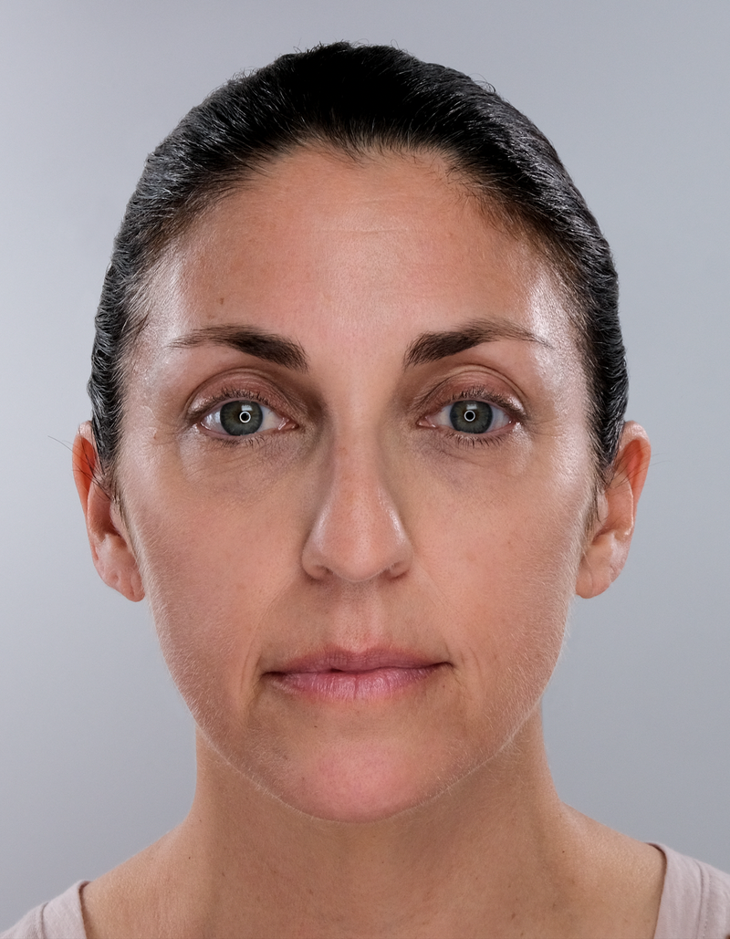 Full-face result before using Sonicsmooth Pro+
