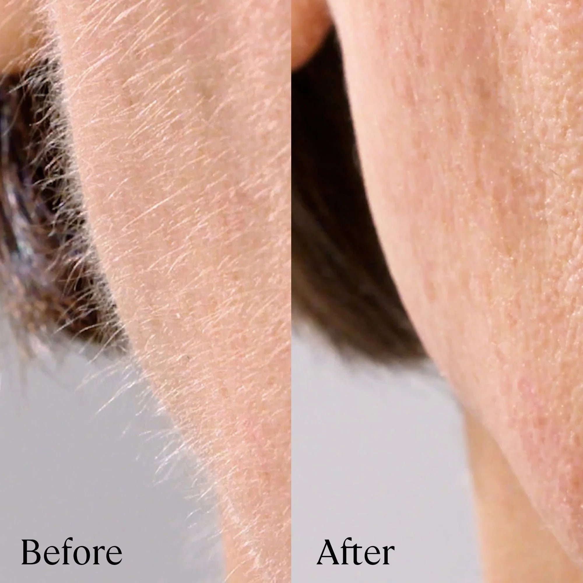 Comparison of facial hair removal: before and after treatment.