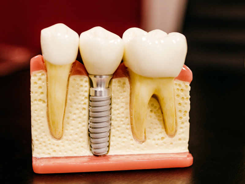 Restore missing teeth and regain your confidence with durable and natural-looking dental implant solutions.