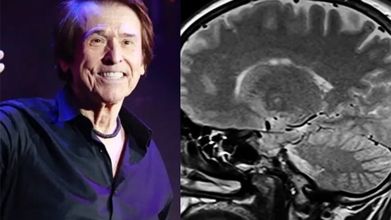 Linfoma cerebral: una amenaza silenciosa que merece más atención y conciencia