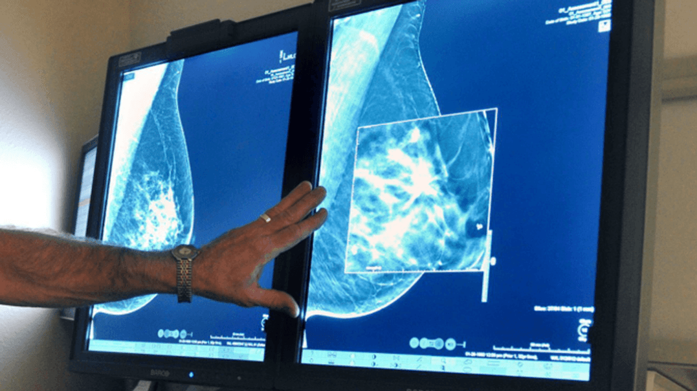 Nuevas regulaciones destacan la importancia de la densidad mamaria en la detección temprana del cáncer.
