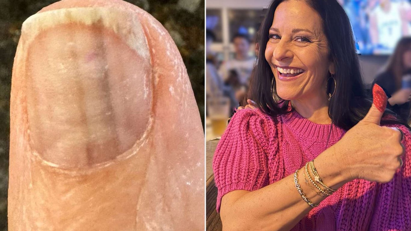 El susto de melanoma de mi madre: una historia de advertencia sobre el cáncer de piel oculto bajo las uñas.