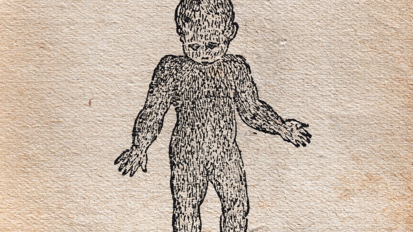 Minoxidil vinculado al "Síndrome del Hombre Lobo" en bebés provoca urgentes advertencias de salud.