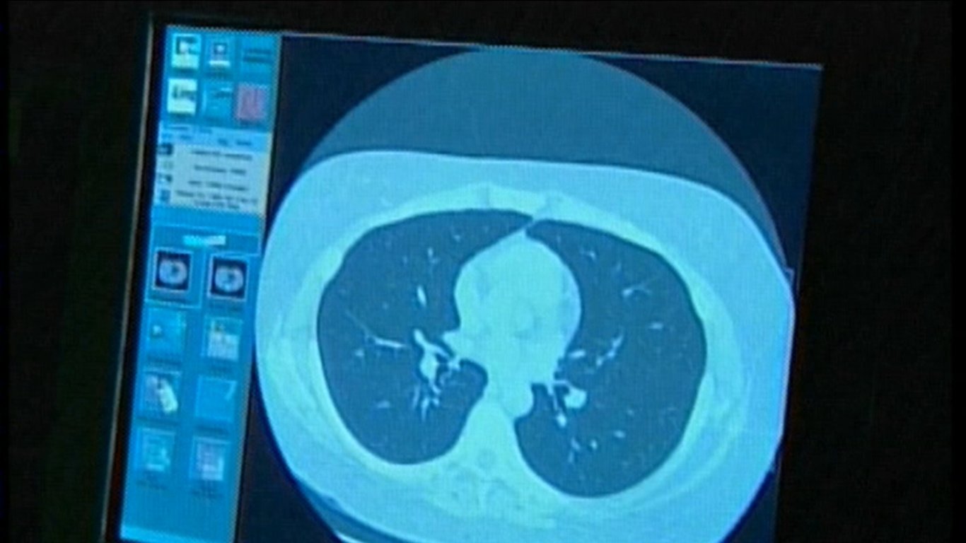 Tendencias Emergentes en el Cáncer de Colon: Jóvenes Adultos en Riesgo y Nuevas Herramientas para la Prevención.