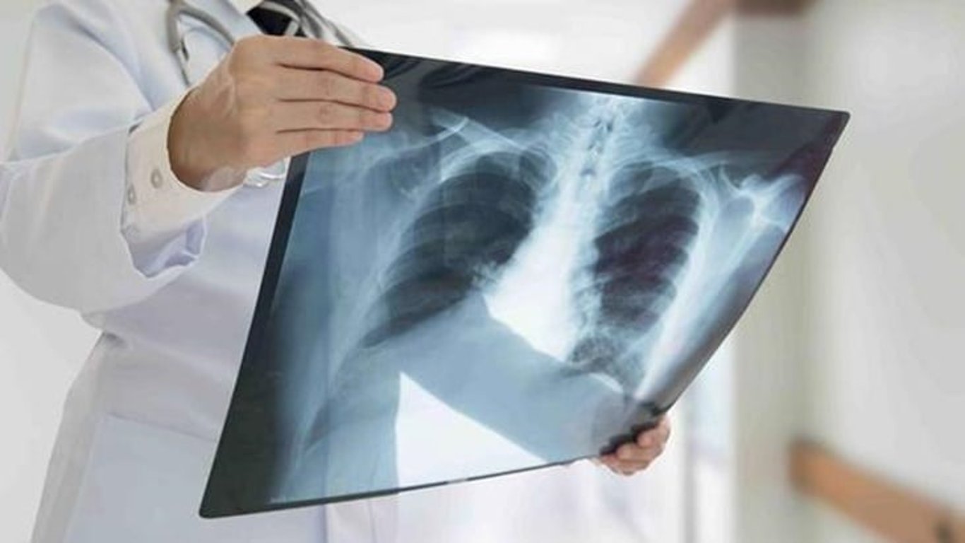 Día Mundial de la Tuberculosis: Urge intensificar prevención y tratamiento en Argentina