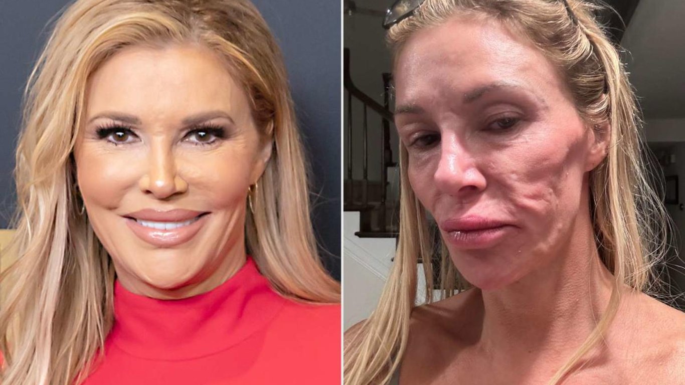 Brandi Glanville habla sobre sus luchas de salud y la profunda depresión por los cambios en su rostro.