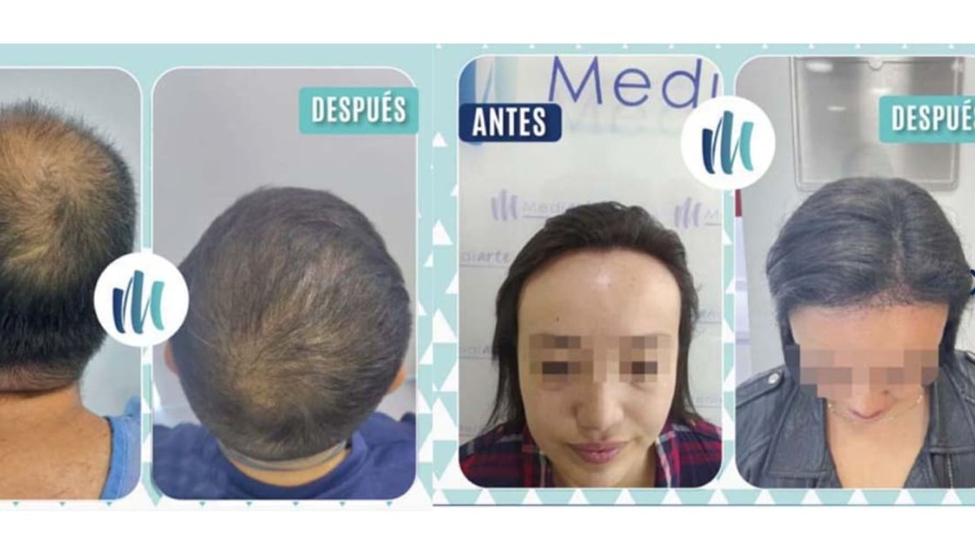 The rise of hair implants among celebrities is transforming aesthetics in Colombia.