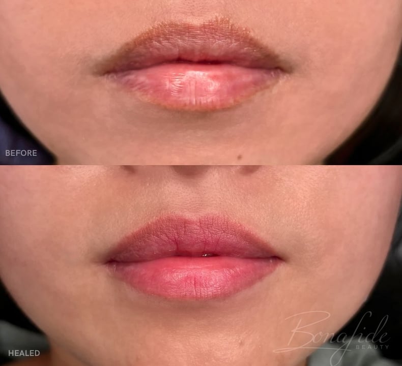 Dark lips before, and the evened-out healed result