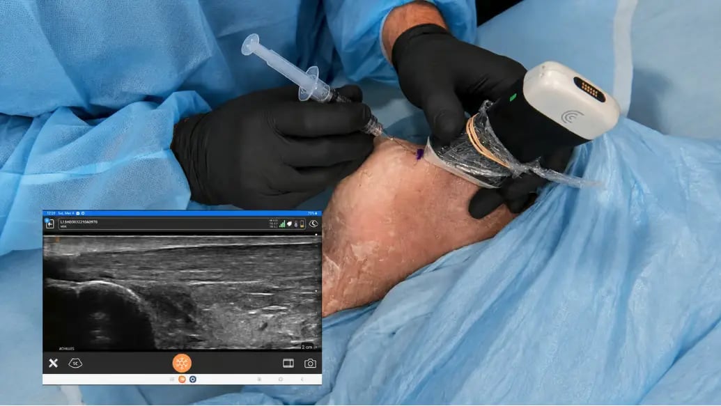 Ultrasound Pain Management
