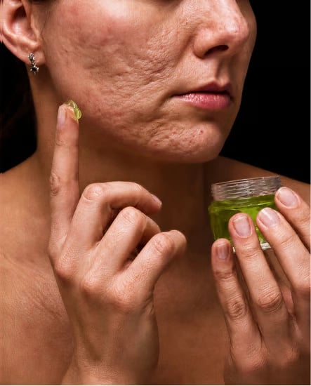 Acne Therapies for an Aesthetic Practice