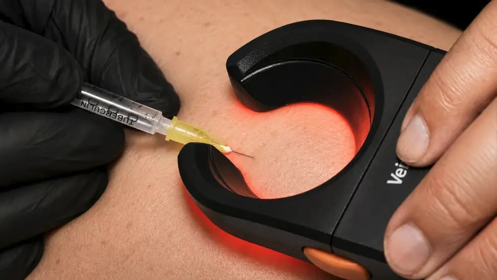 Sclerotherapy for Physicians & Nurses