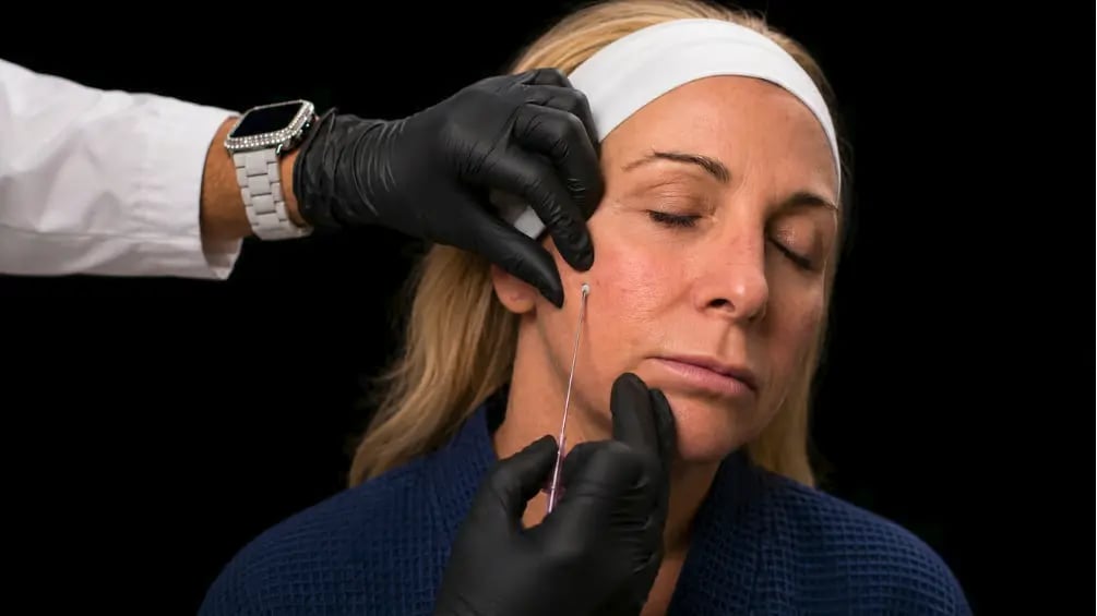 Advanced PDO Thread Lift Training (Level III)
