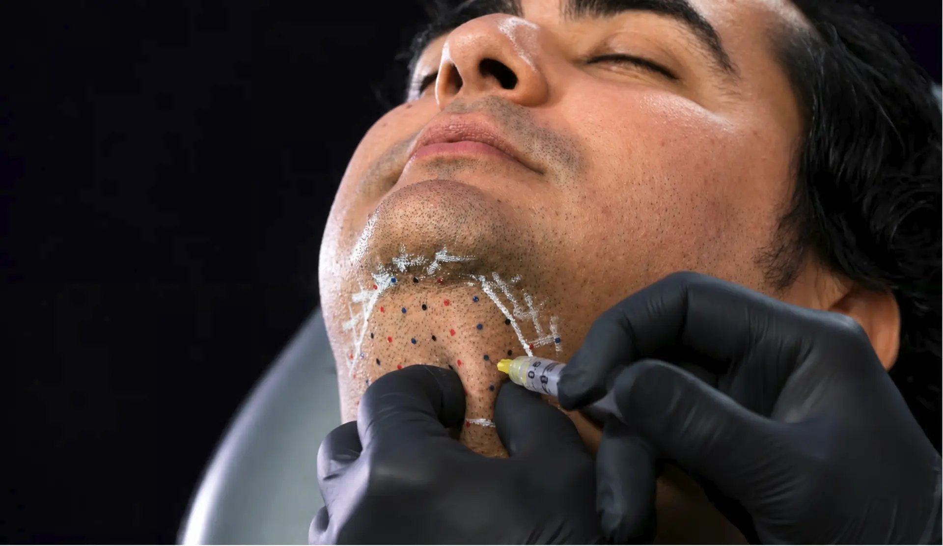 Kybella® & Mesotherapy Training for Face & Body Contouring
