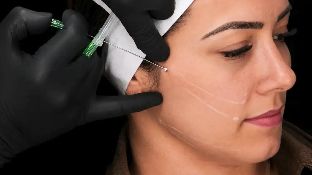 PDO Thread Lift Training (Level II)