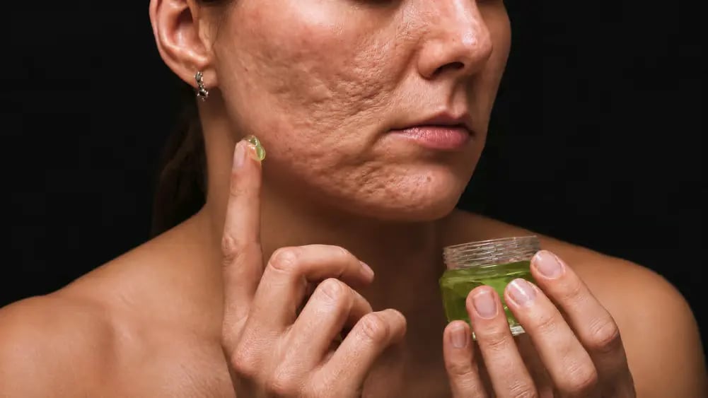 Acne Therapies for an Aesthetic Practice