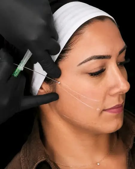 PDO Thread Lift Training (Level II)