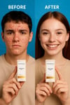 Anti-acne Serum 10 Ml | Akne Karşıtı, Kurutucu, Cilt Arındırıcı Serum