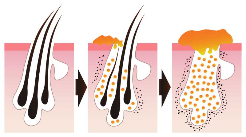 seborrea capelli