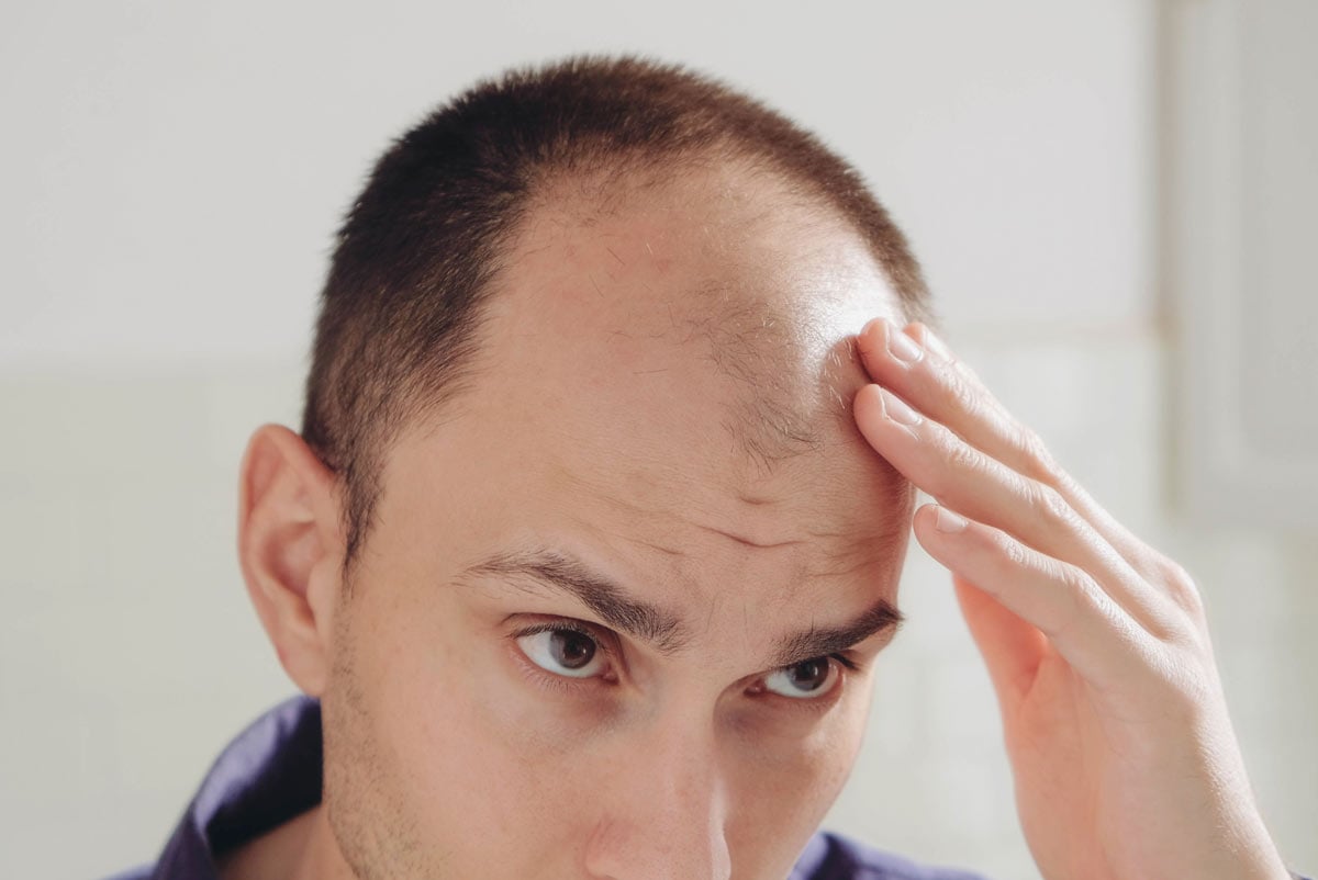 alopecia androgenetica
