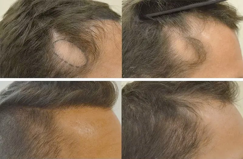 cause caduta capelli alopecia areata centri specializzati caso prima dopo