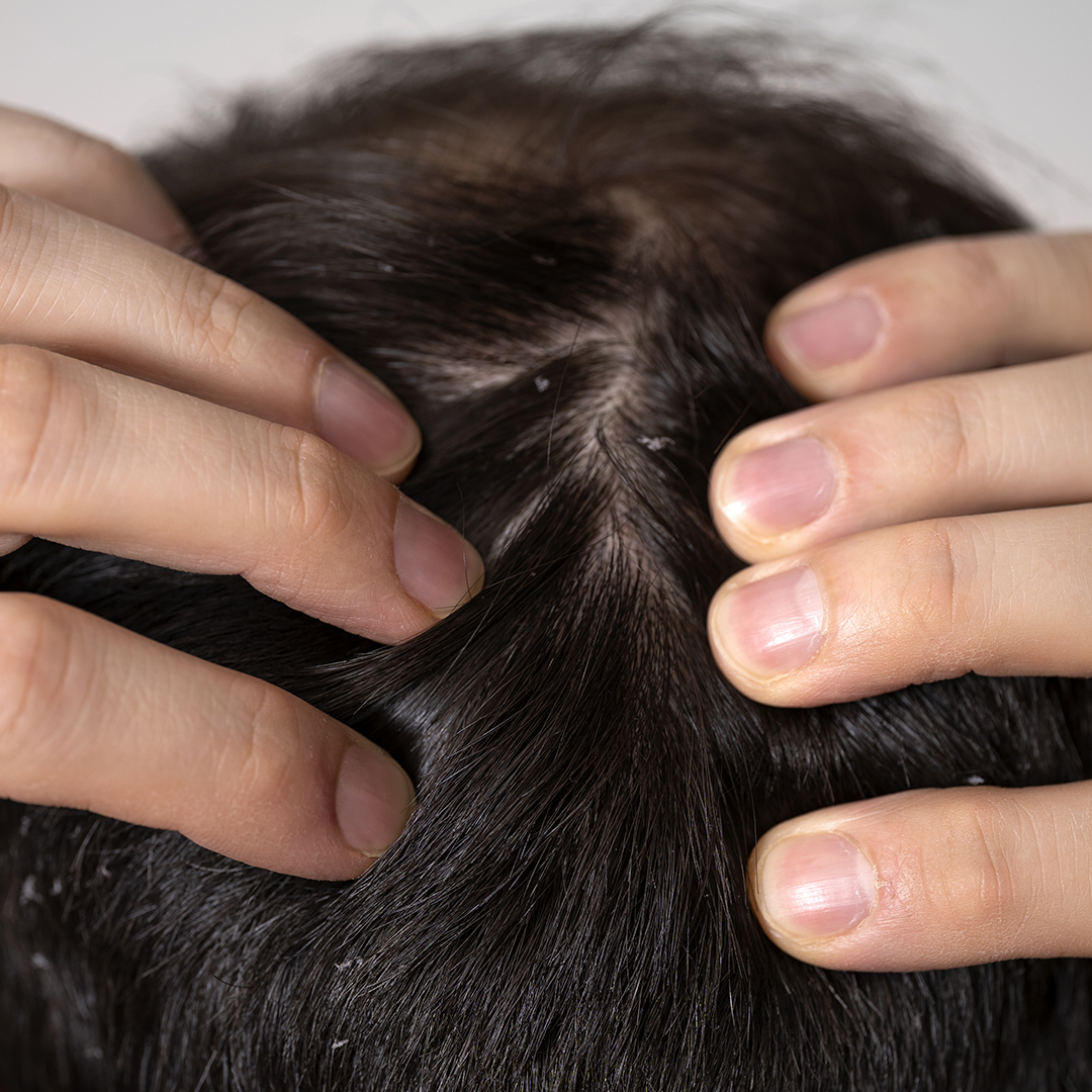 Altre tipologie di alopecia seborroica