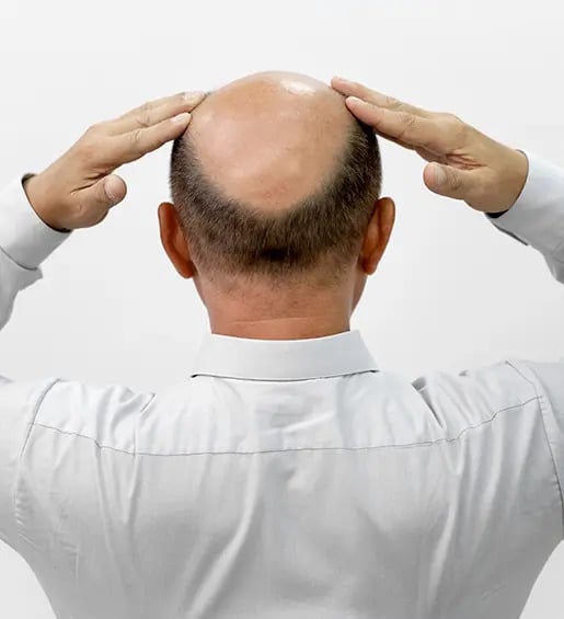 Alopecia androgenetica