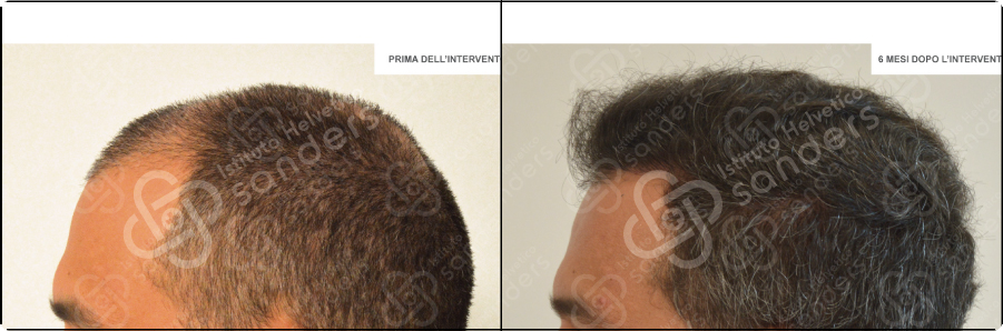 Risultati prima dopo trapianto zona laterale 18