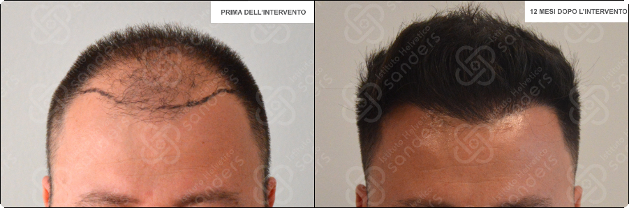 Risultati prima dopo trapianto zona frontale caso 1