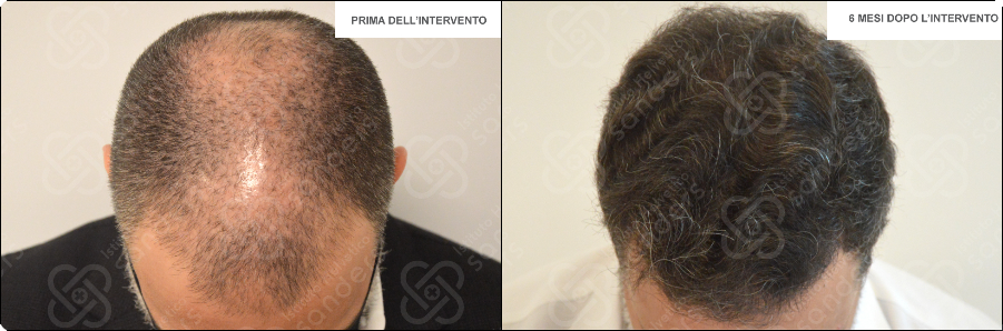 Risultato trapianto zona frontale caso 2
