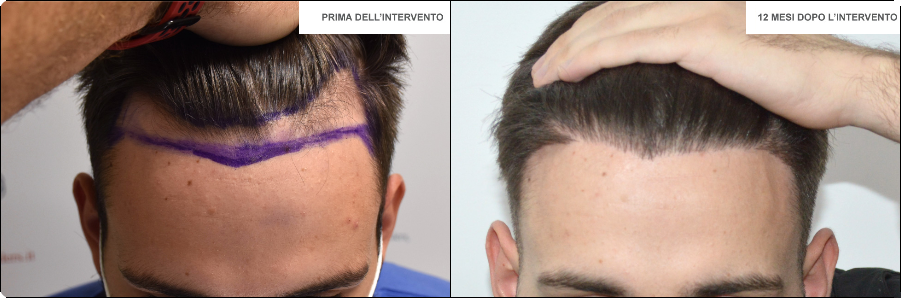 Risultato trapianto zona frontale caso 3