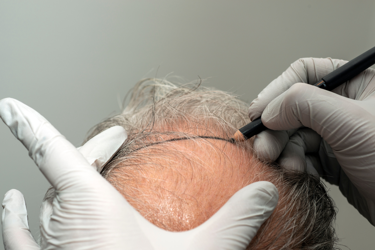 Trapianto di capelli: come funziona, tecniche, procedure e costi