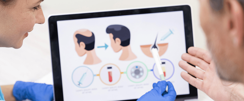 Sanders Trapianto di capelli Protocollo SMART FUE