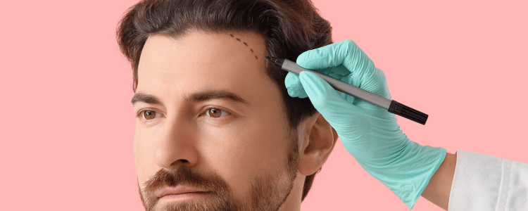 Trapianto di capelli:: cosa sapere prima di decidere