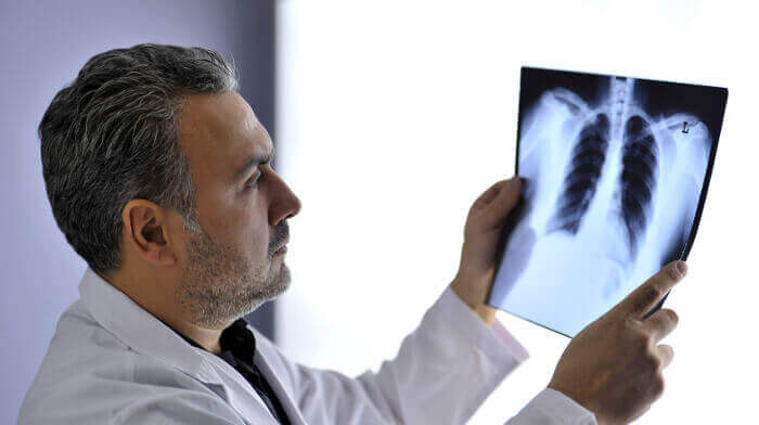 Doctor examining lung Xray