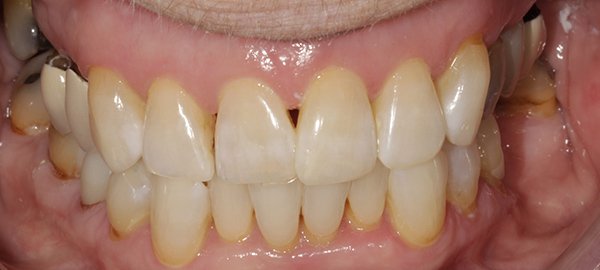 Fletcher-after-bleaching Fletcher-after-bleaching