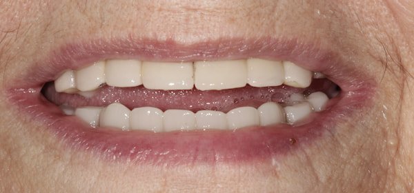 after implant supported overdenture top and bottom-web After
