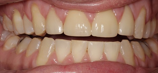 after2-veneers-web Veneers after