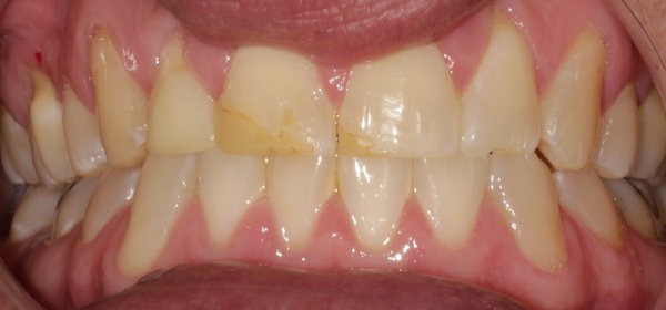before-veneers-web Veneers before