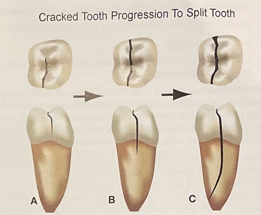 cracked tooth