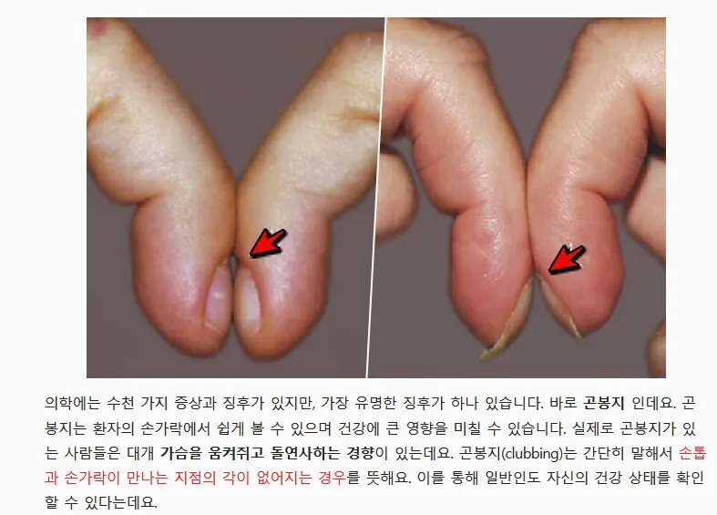 손가락 모양으로 간단히 건강 진단하는 법 4