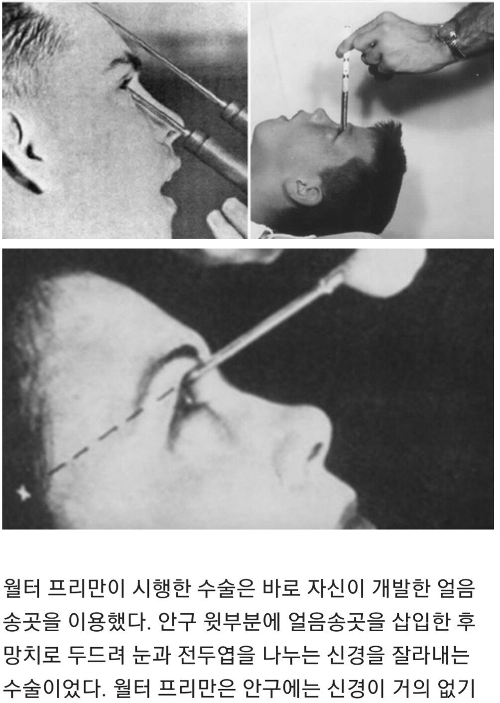 검증되지 않은 뇌 전두엽 제거 수술받은 케네디가 불행한 여인 10