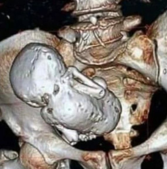 신기한 임신 사실들 네가지 2