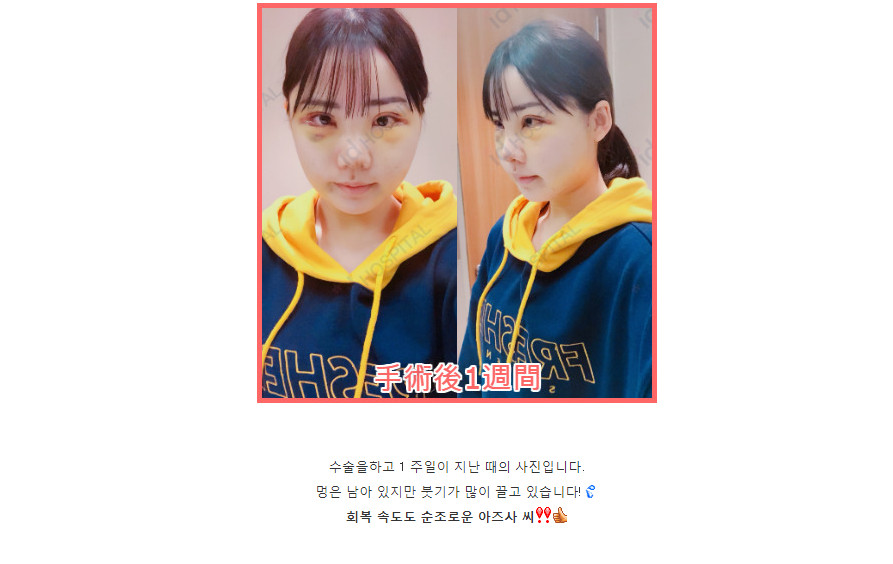 AV 배우 후카다 에이미에 강남 성형 성공기 4