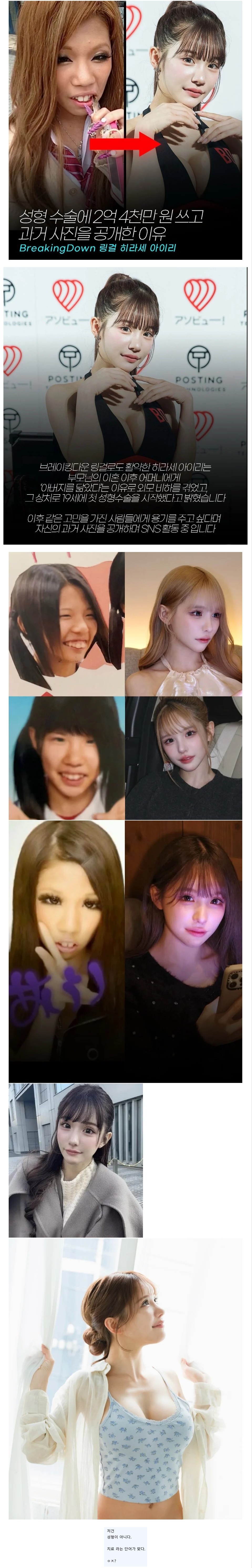 성형수술에 2억4천만원 쓰고 과거사진 공개한 인플루언서