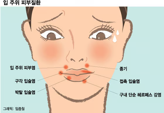 와 입술에 뾰루지 짯는데