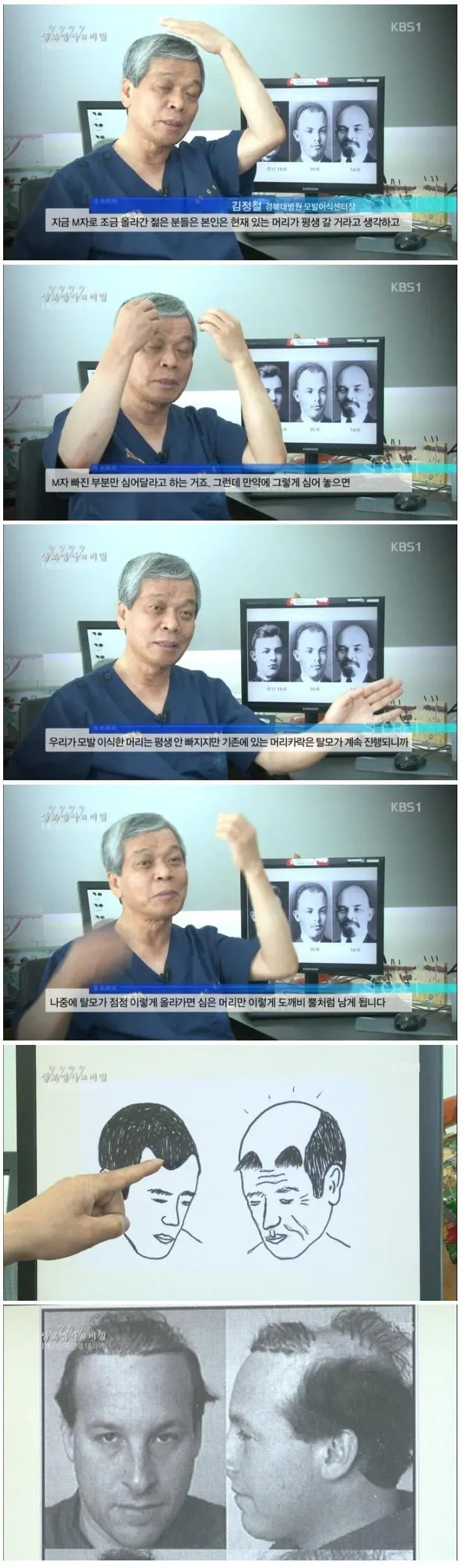 M자 탈모라고 방심하면 안돼는 이유