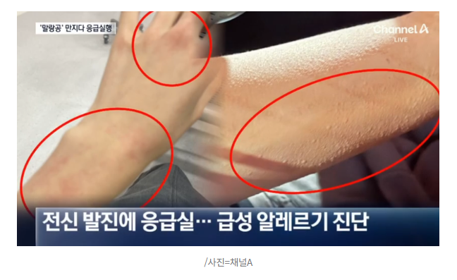 '이 장난감' 만졌다가 '얼굴 퉁퉁'... 급성 알레르기로 응급실행 3