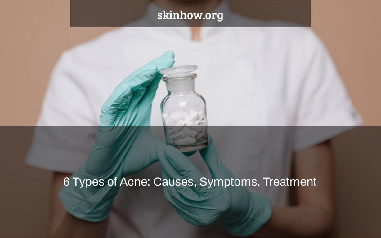 6 Types of Acne: Causes, Symptoms, Treatment